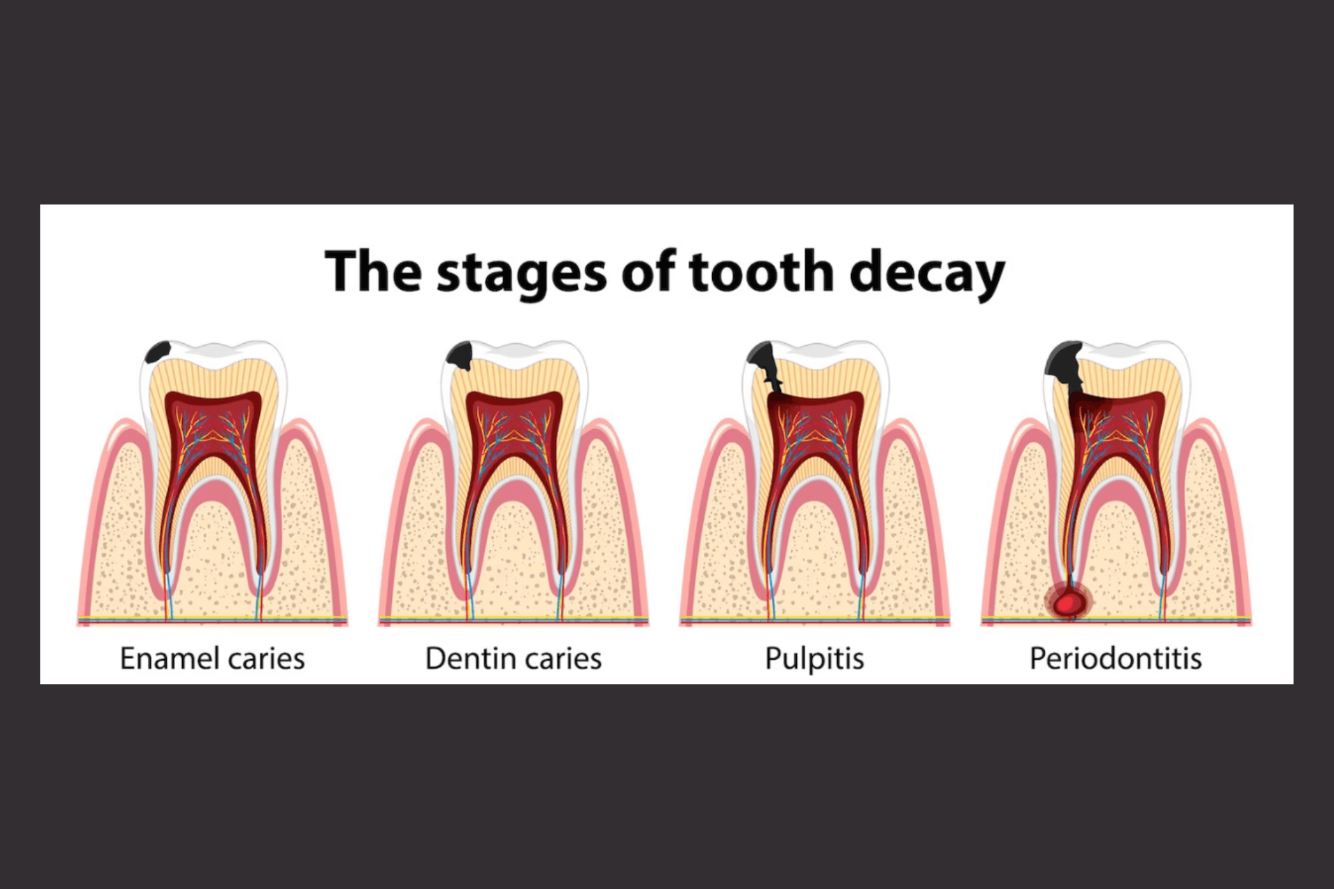 Tooth Decay: What is It? How to Treat and Prevent - QPIOR