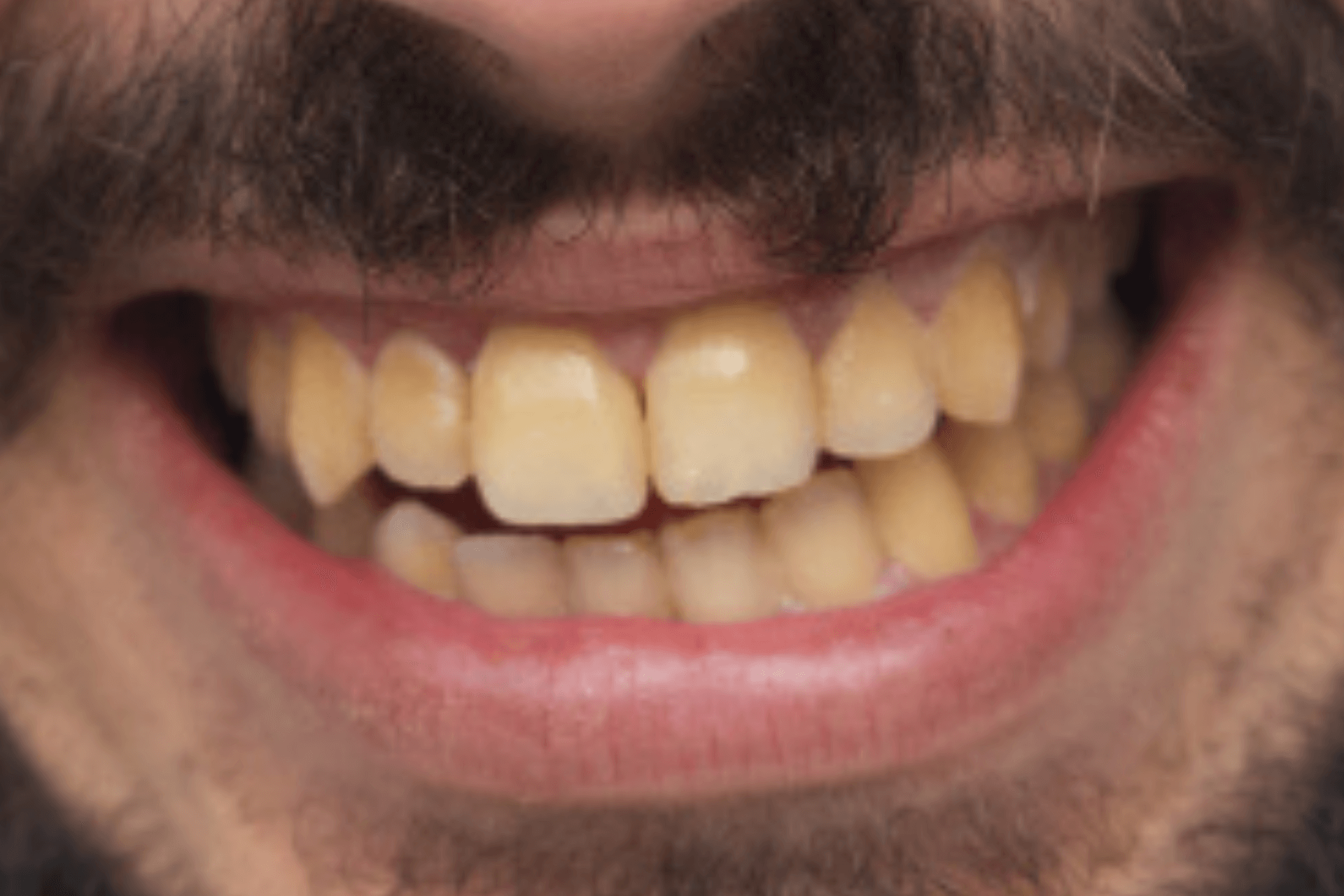 Teeth Discoloration What You Need To Know Qpior 8090