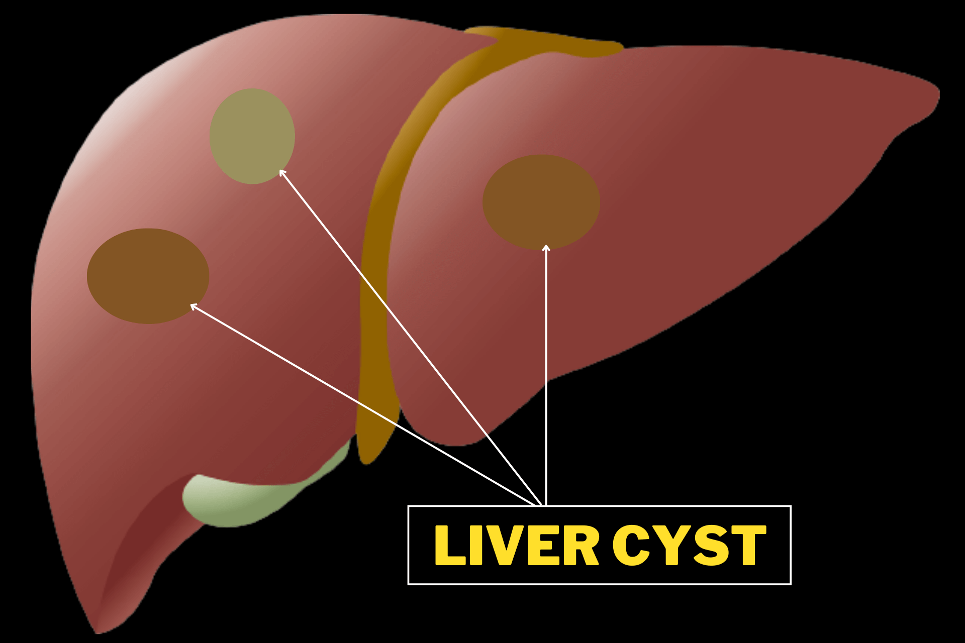 liver-cyst-what-is-it-how-to-prevent-and-treat-qpior