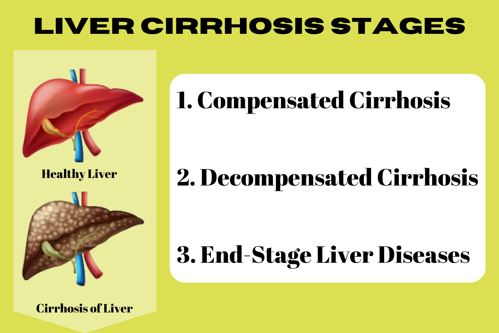 Liver Cirrhosis: How To Cure? Everything You Need To Know - QPIOR